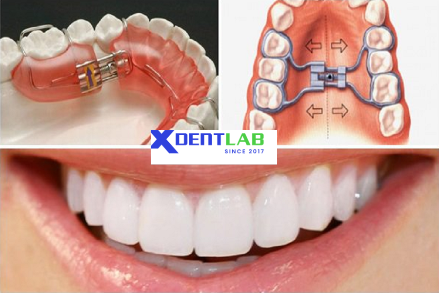 Introduce Global orthodontic device fabrication